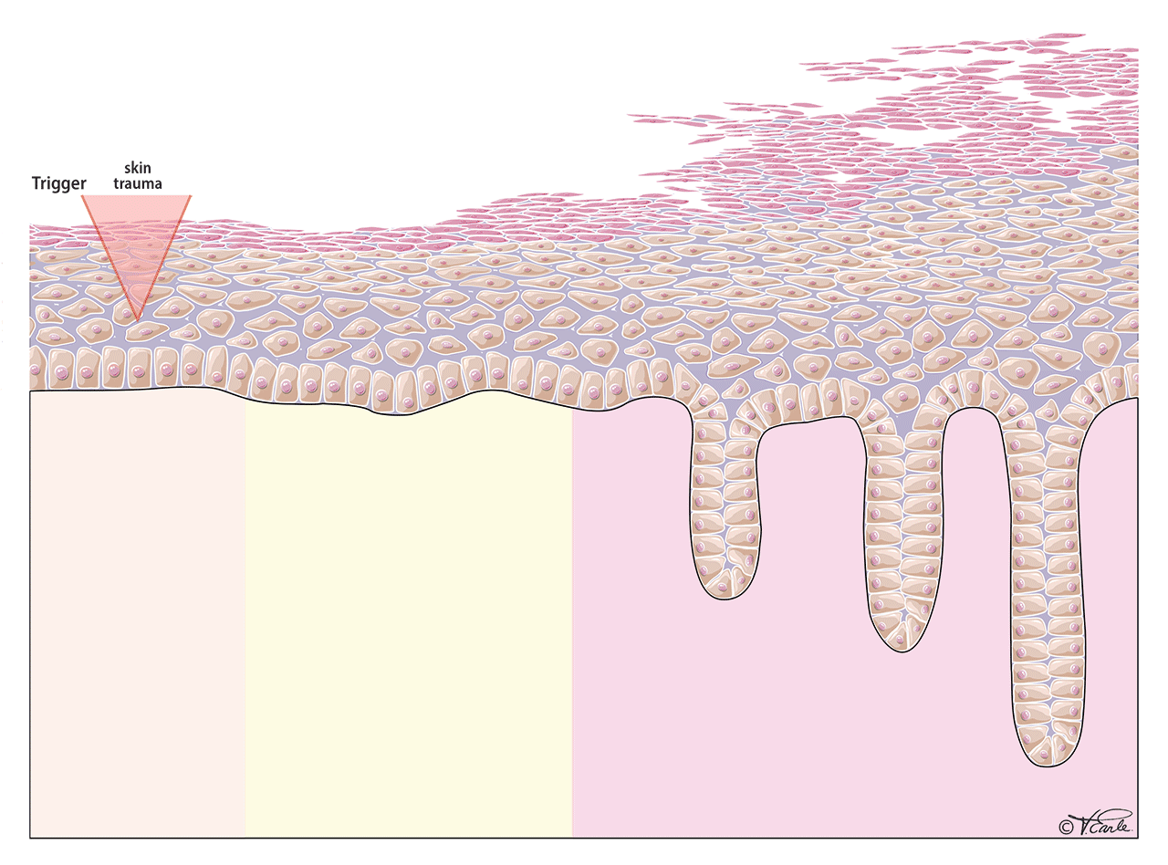 Fig. 3 Psoriasis Cycle for GIF Final 2 EN