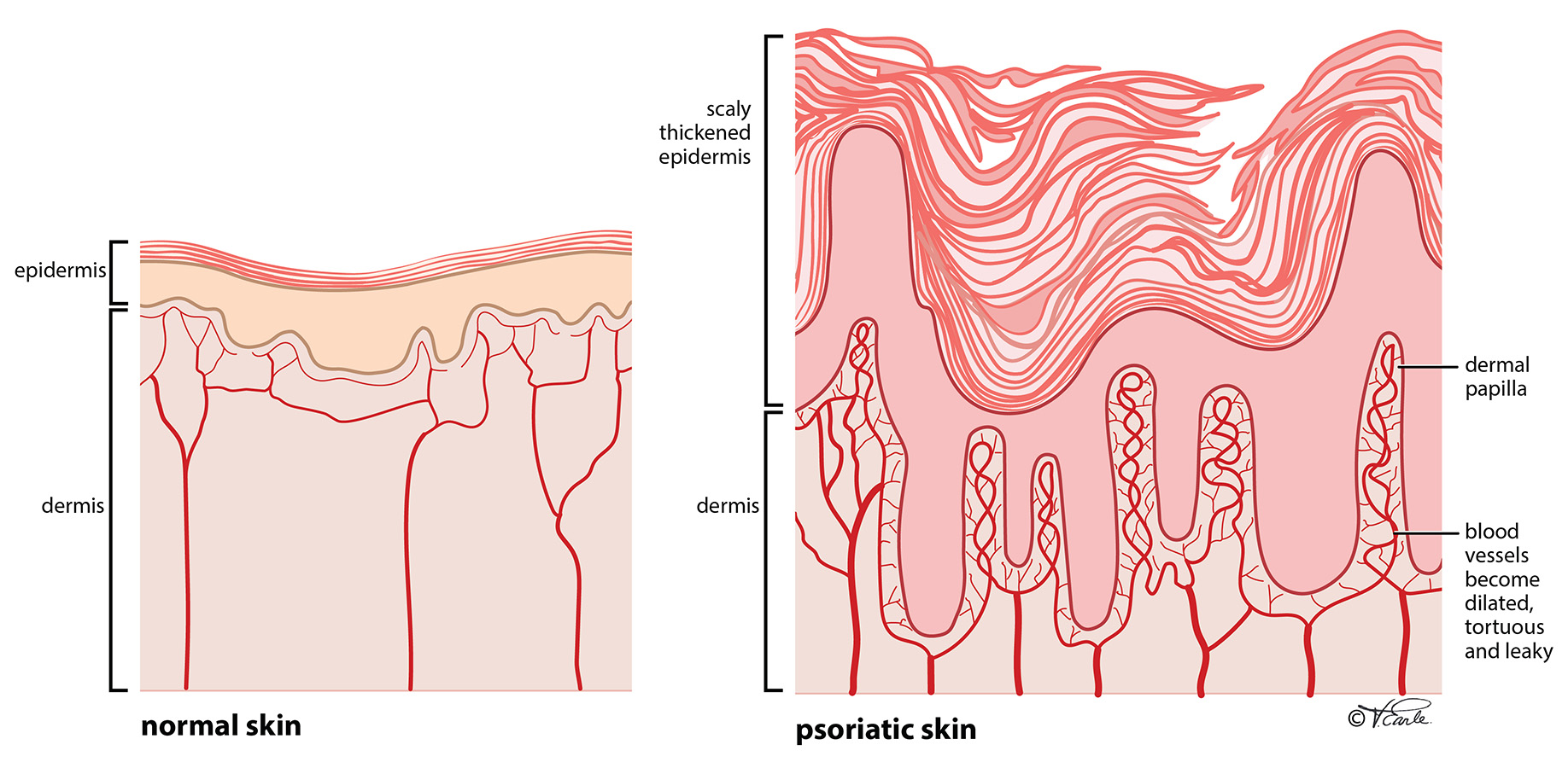 Fig 1 normal skin vs psoriasis Final EN