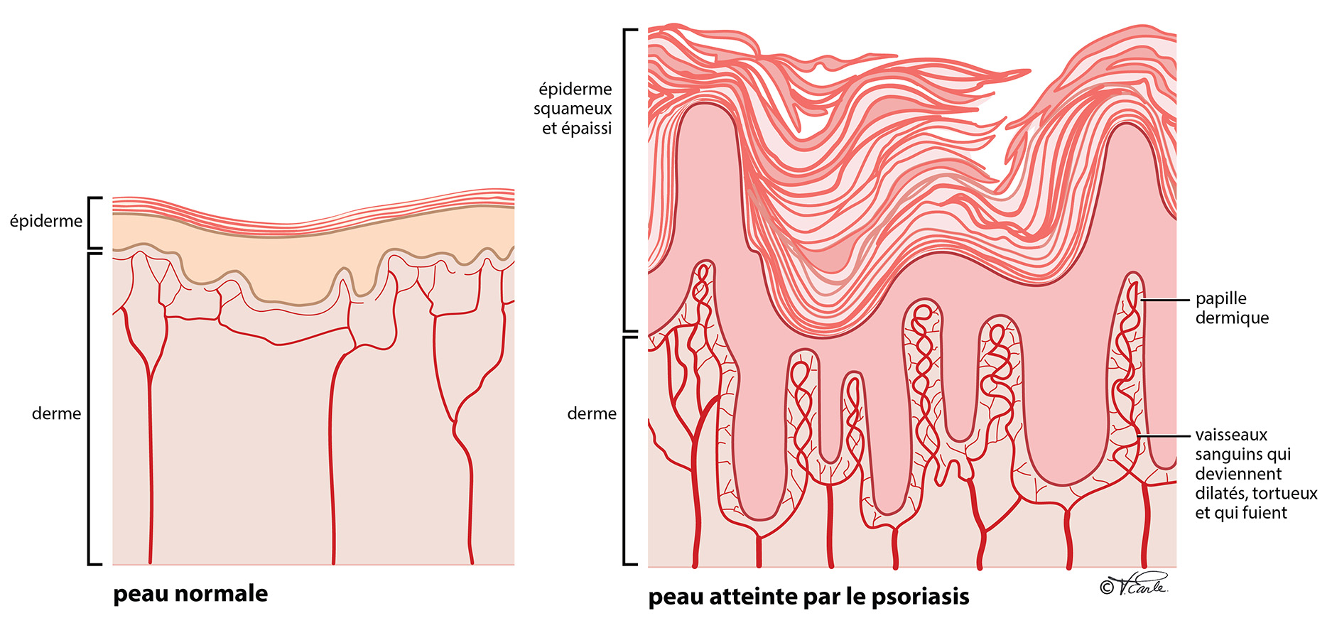 Fig 1 normal skin vs psoriasis Final FR